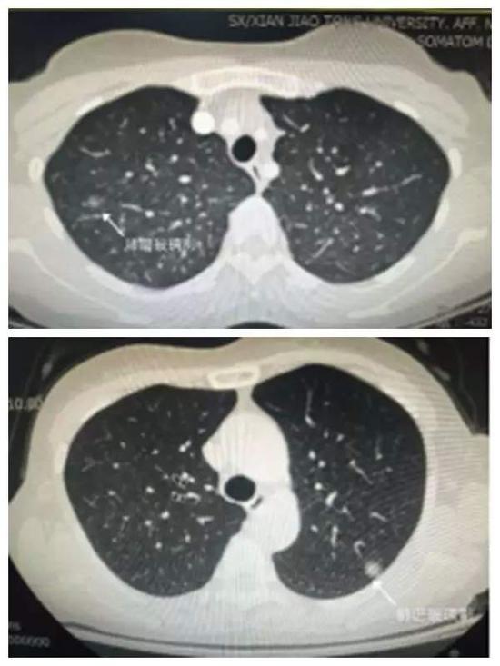 女子肺部磨玻璃结节癌变理赔遭拒，健康保险与医疗纠纷的复杂问题透视