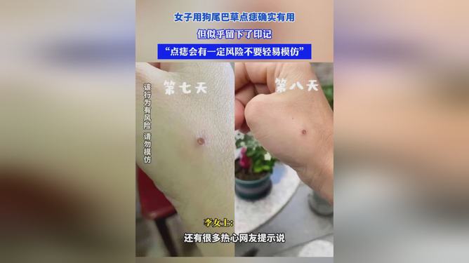 狗尾巴草点痣能否让痣消失？揭秘真相