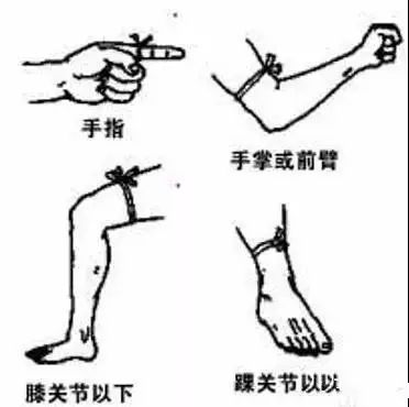 家庭急救指南，切割伤的止血与急救技巧